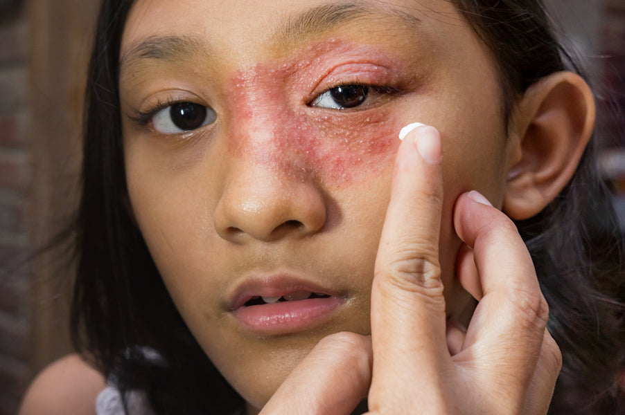Eczema Cream for Face: Treatment Tips for Sensitive Skin