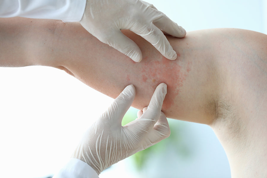 Prescription Eczema Cream: Try This Effective Treatment