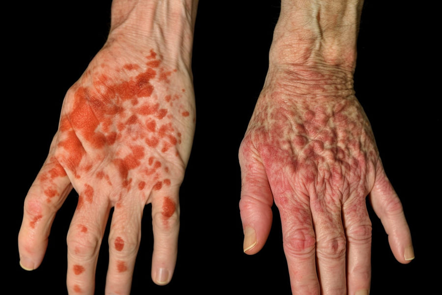 Psoriasis Vs Eczema: The Key Differences You Need To Know